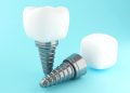 3d Dental tooth implant.