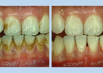 亮白後潔白牙齒