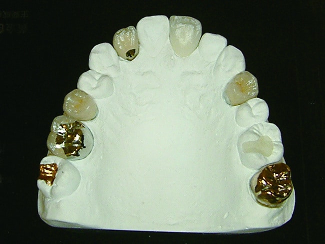 P088-1-各種材質假牙