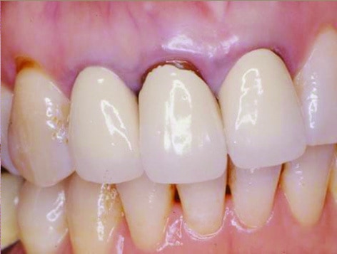 P090-4-牙齦顏色變暗-1