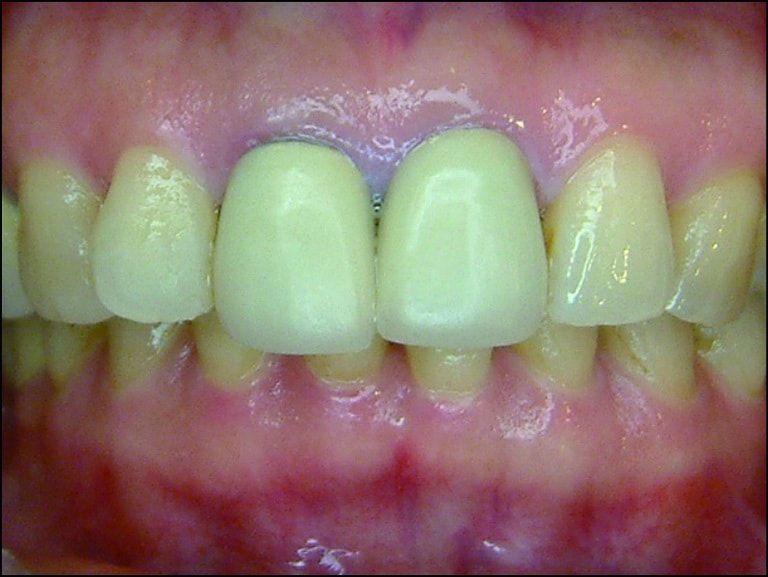 P090-5-假牙缺乏透明感