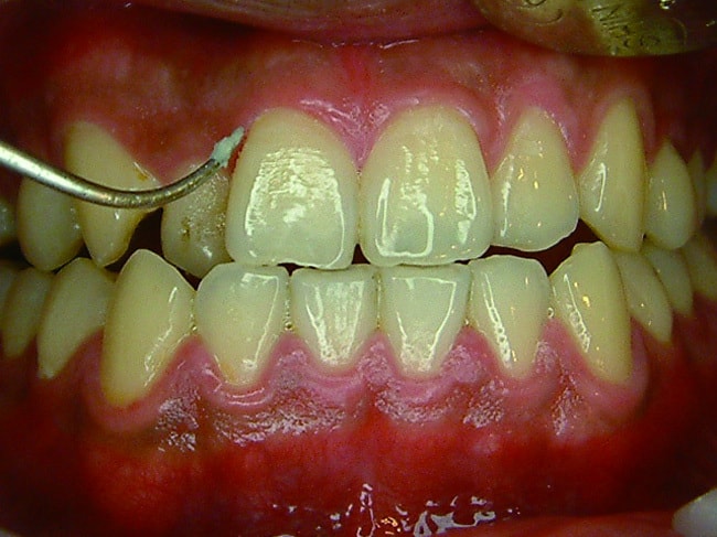 P102-1-牙菌斑
