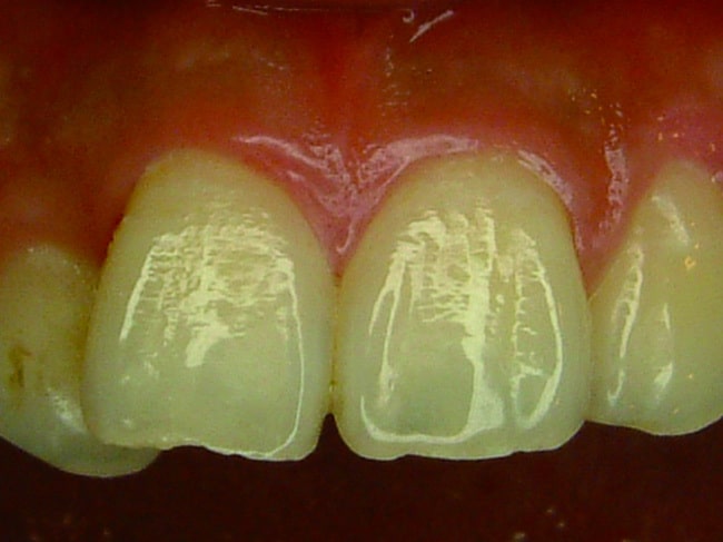 P102-2-病患上排健康的牙齦