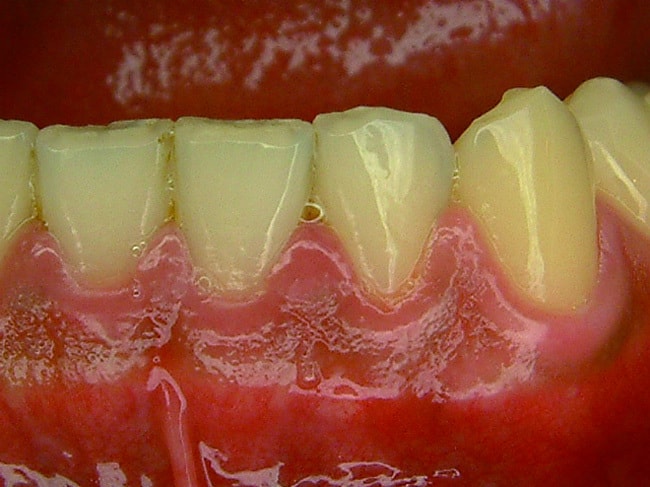 P102-3-下排牙齒間的1FBE01