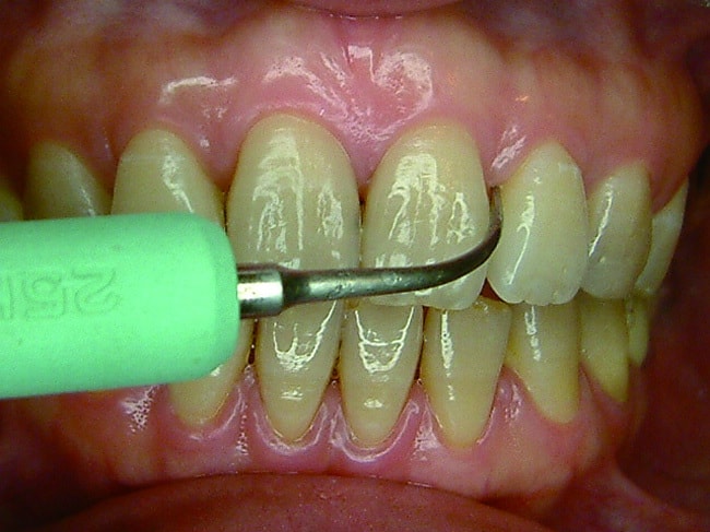 P113-1-超音波洗牙