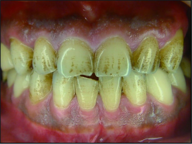 P113-6-牙齒凹縫受到1D97C6