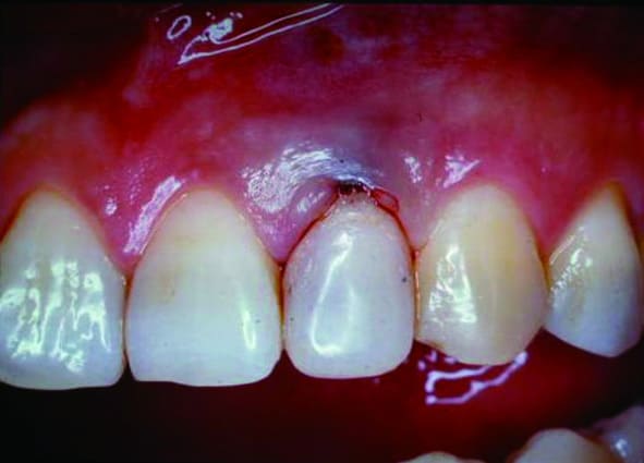 P127-5-裝上活動性過渡假牙