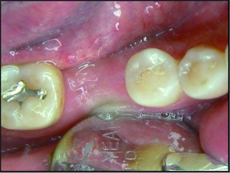 P127-8-缺牙，評估進1D981D