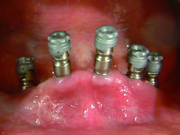 P138-4-植入人工牙根