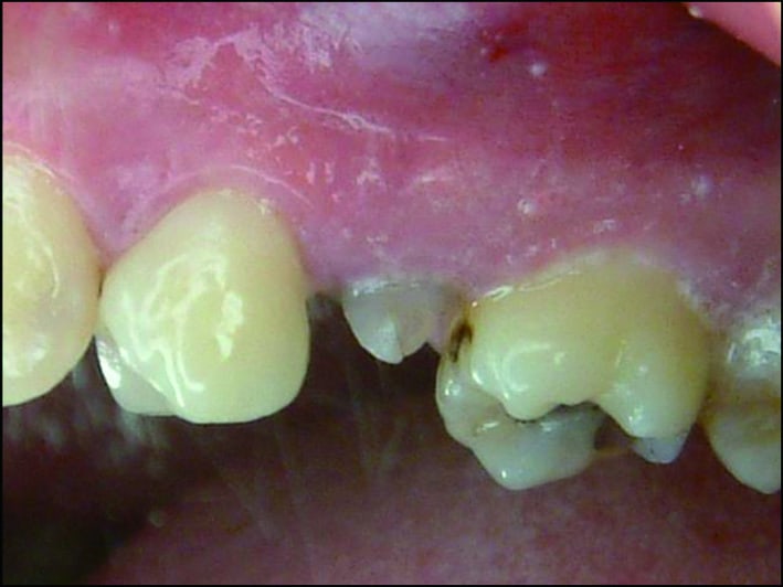 P139-1-牙齒斷裂，需1EDF63