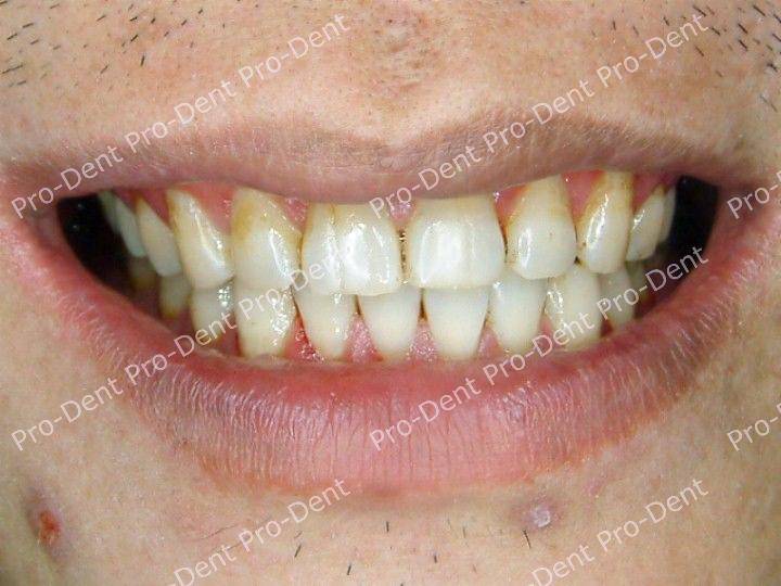 口腔SPA-柏登牙醫案例分享-案例五3-治療後