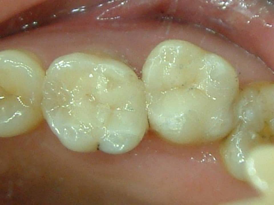 V2-1防護拆銀粉後患局部牙冠-後-柏登牙醫