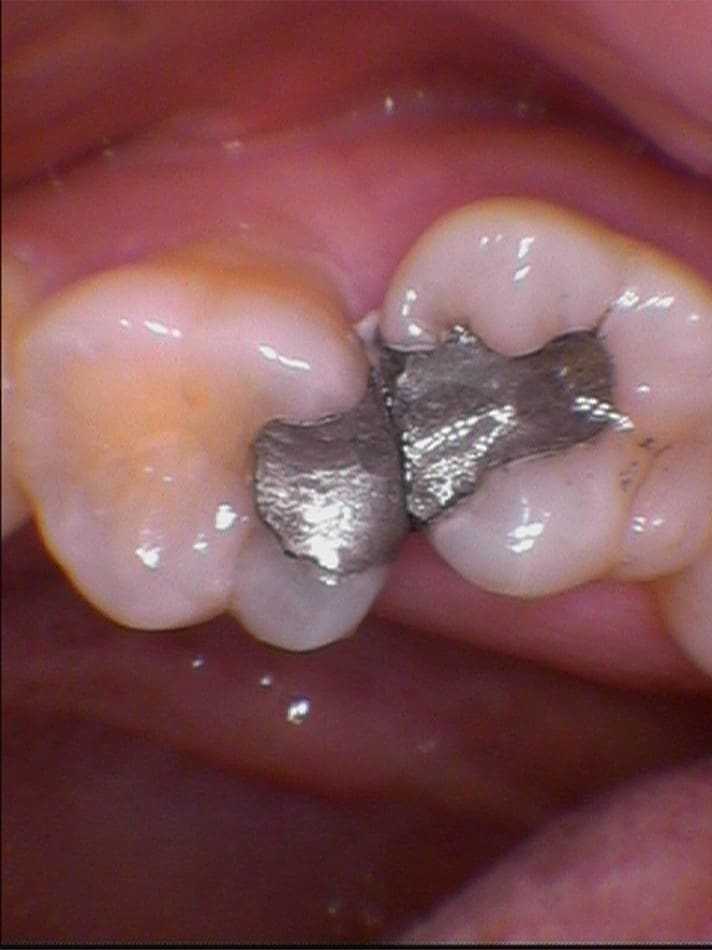 V2防護拆銀粉後患局部牙冠-前-柏登牙醫