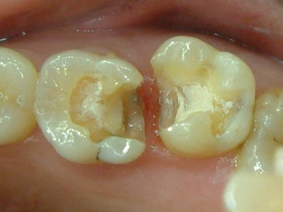 V2防護拆銀粉後患局部牙冠-後-柏登牙醫