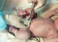 Close-up doctor obstetrician nurse cutting umbilical cord with medical scissors to newborn baby