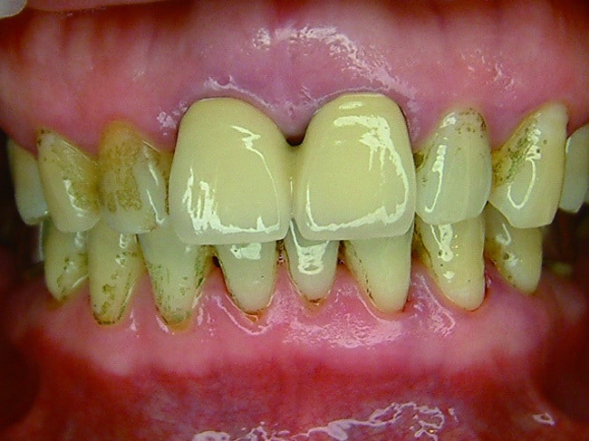 p060-3-牙齒上有牙菌斑
