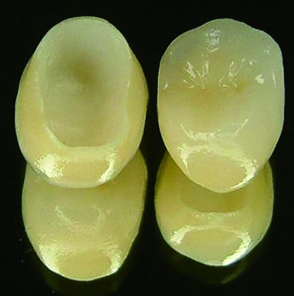 p087-3-瓷牙冠