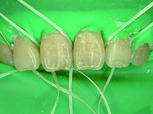 p113-4-以橡皮障保護牙齦
