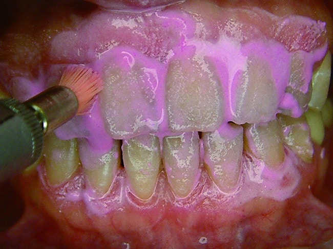 p116-2-清潔與拋光牙齒