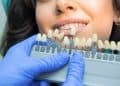 Tooth whitening chart