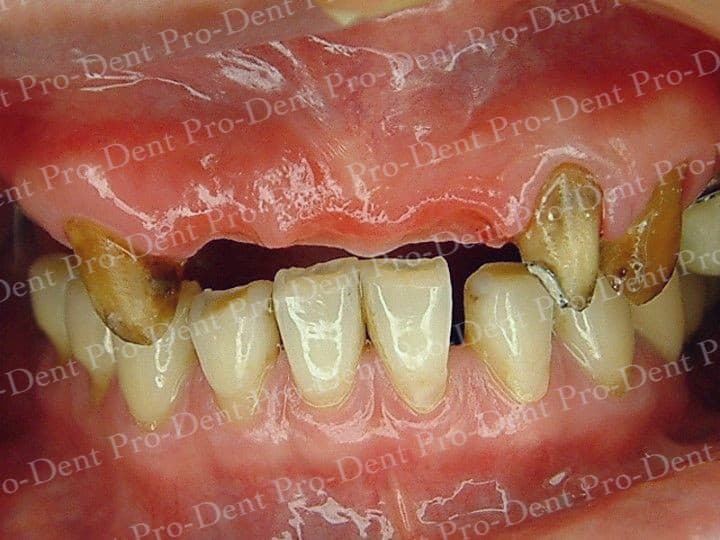 人工植牙-柏登牙醫案例分享-案例一1-结果-1-1