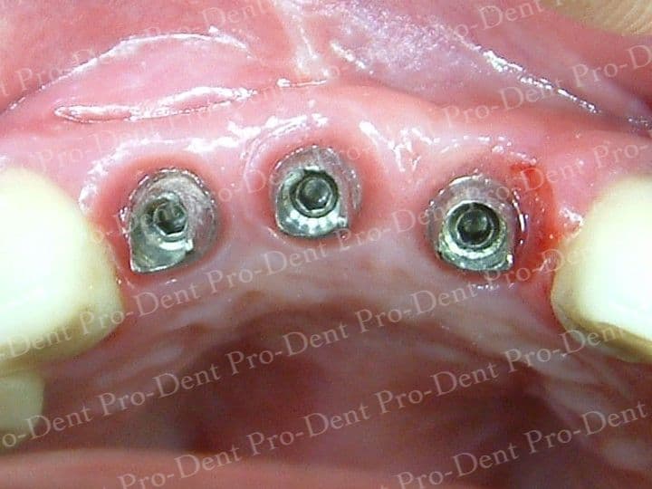 人工植牙-柏登牙醫案例分享-案例一2-结果-3