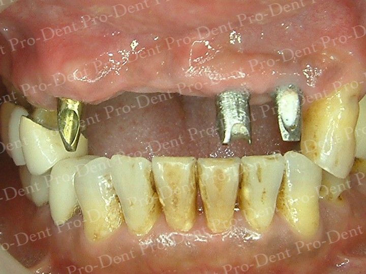 人工植牙-柏登牙醫案例分享-案例二2-结果-1