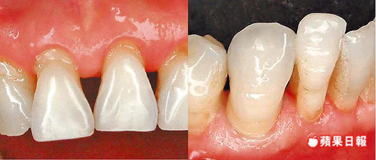 刷牙太過認真-竟致牙齦萎縮-柏登牙醫-牙齦萎縮2