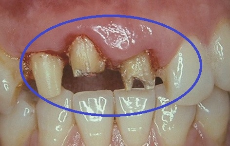 前牙牙齒排列不整牙肉不對稱