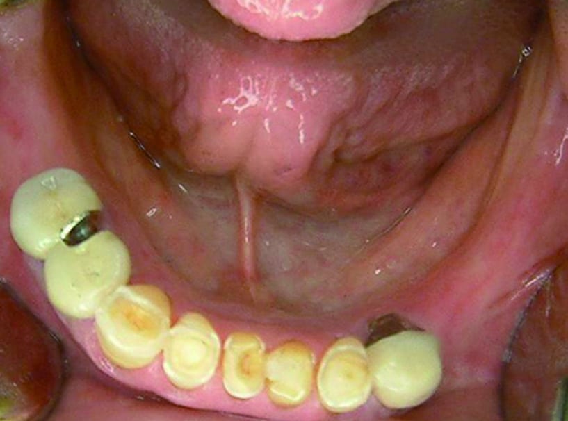 前牙過度磨損