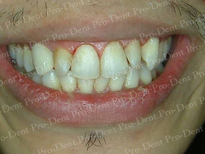 口腔SPA-柏登牙醫案例分享-案例三2-结果-3