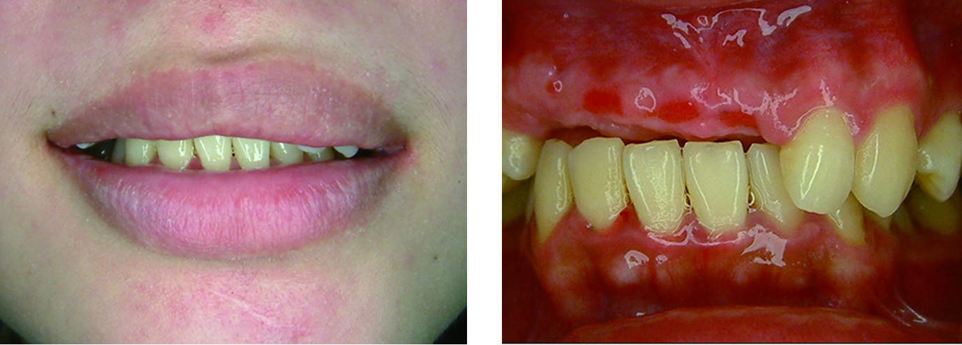 右側區牙造成唇型塌陷左右不對稱