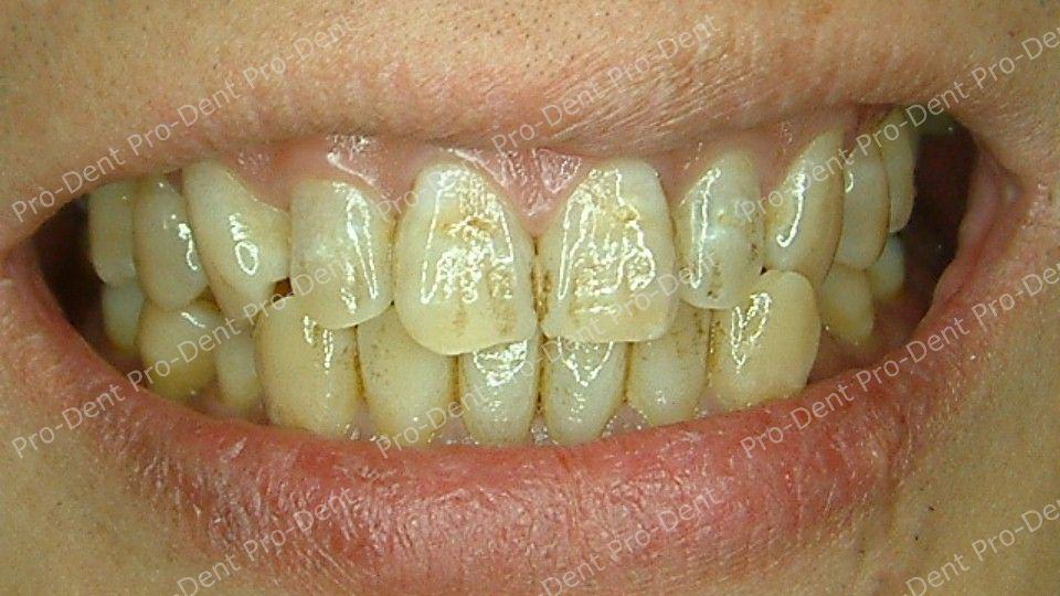口腔SPA-柏登牙醫案例分享-案例七1-治療前