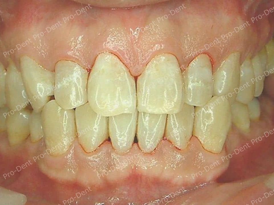 口腔SPA-柏登牙醫案例分享-案例七-治療後