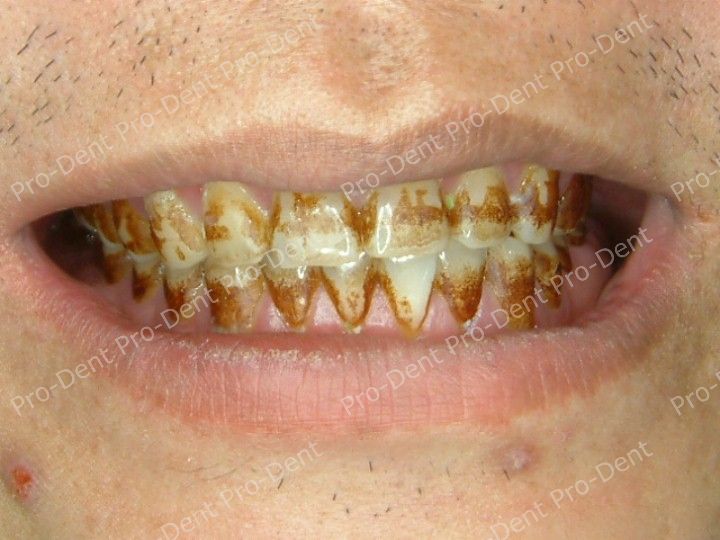 口腔SPA-柏登牙醫案例分享-案例五1-治療前
