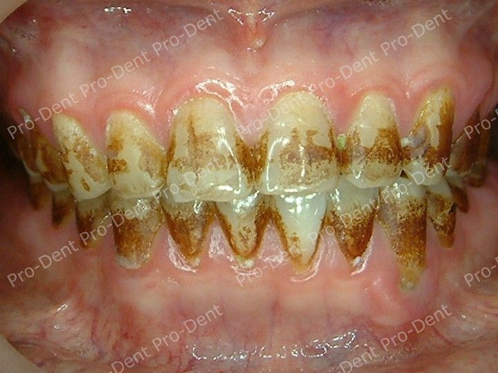 口腔SPA-柏登牙醫案例分享-案例五2-治療前