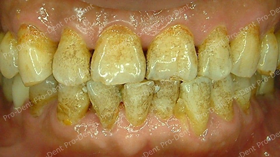 口腔SPA-柏登牙醫案例分享-案例六2-治療中