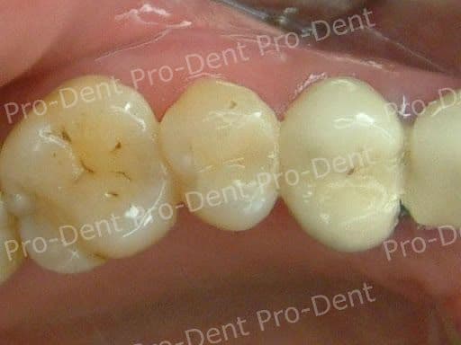 局部牙冠(3D齒雕)案例分享-治療後