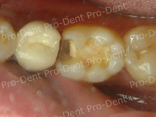 局部牙冠(3D齒雕)案例分享-治療前