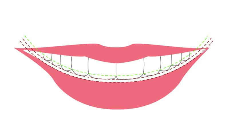 微笑線由上而下為牙齒接觸點連線上排牙齒切端連線下唇上緣線
