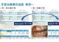 止鼾-柏登牙醫案例分享-案例一2-结果