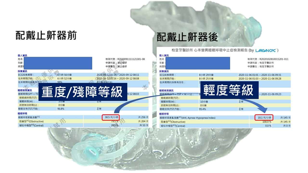 止鼾牙醫-前後數值-柏登牙醫