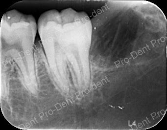 牙齒保存術-牙周病之齒槽骨脊保存手術-治療前