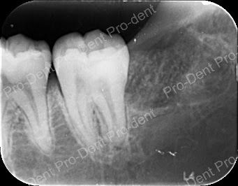 牙齒保存術-牙周病之齒槽骨脊保存手術-治療中