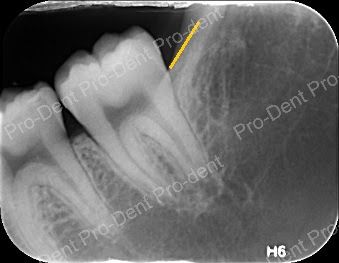 牙齒保存術-牙周病之齒槽骨脊保存手術-治療後