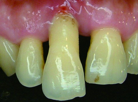 牙周病造成牙齦上移-2