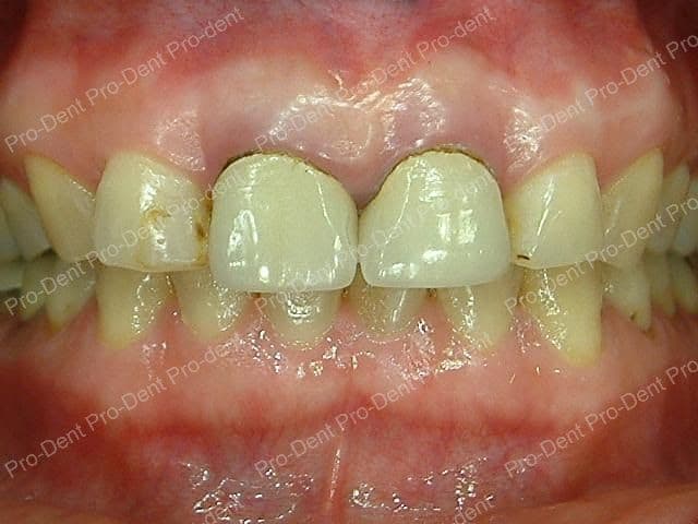 牙齒保存術-牙周病之牙冠增長手術-治療前
