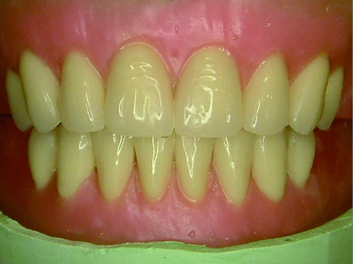 牙根比牙冠稍偏離中心排列