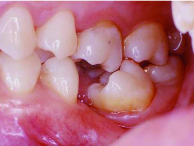 牙齒排列不整造成位移