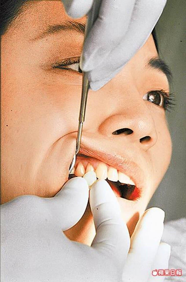 牙齒美白激增3成-六月結婚潮-柏登牙醫-美白牙齒衛教7-2